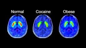 Regiones cerebrales activadas en un cerebro sano, un cerebro adicto a la cocaína y un cerebro adicto al azúcar