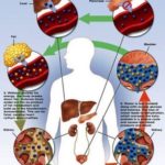 Esquema de Cetoacidosis Diabética